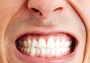 Amit a fogcsikorgatásról tudni akartál